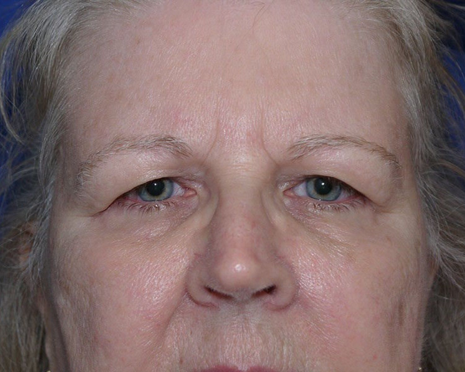 Eyelid Surgery before