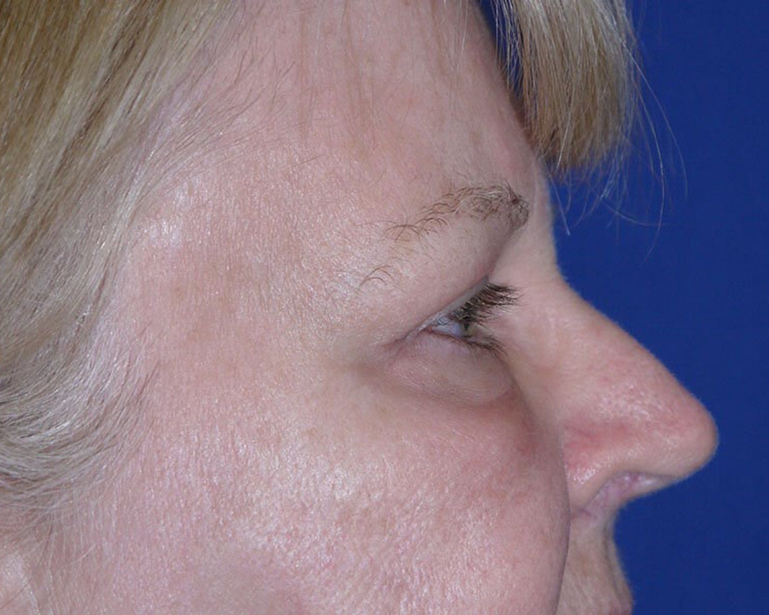 Eyelid Surgery, Oblique Right view, after