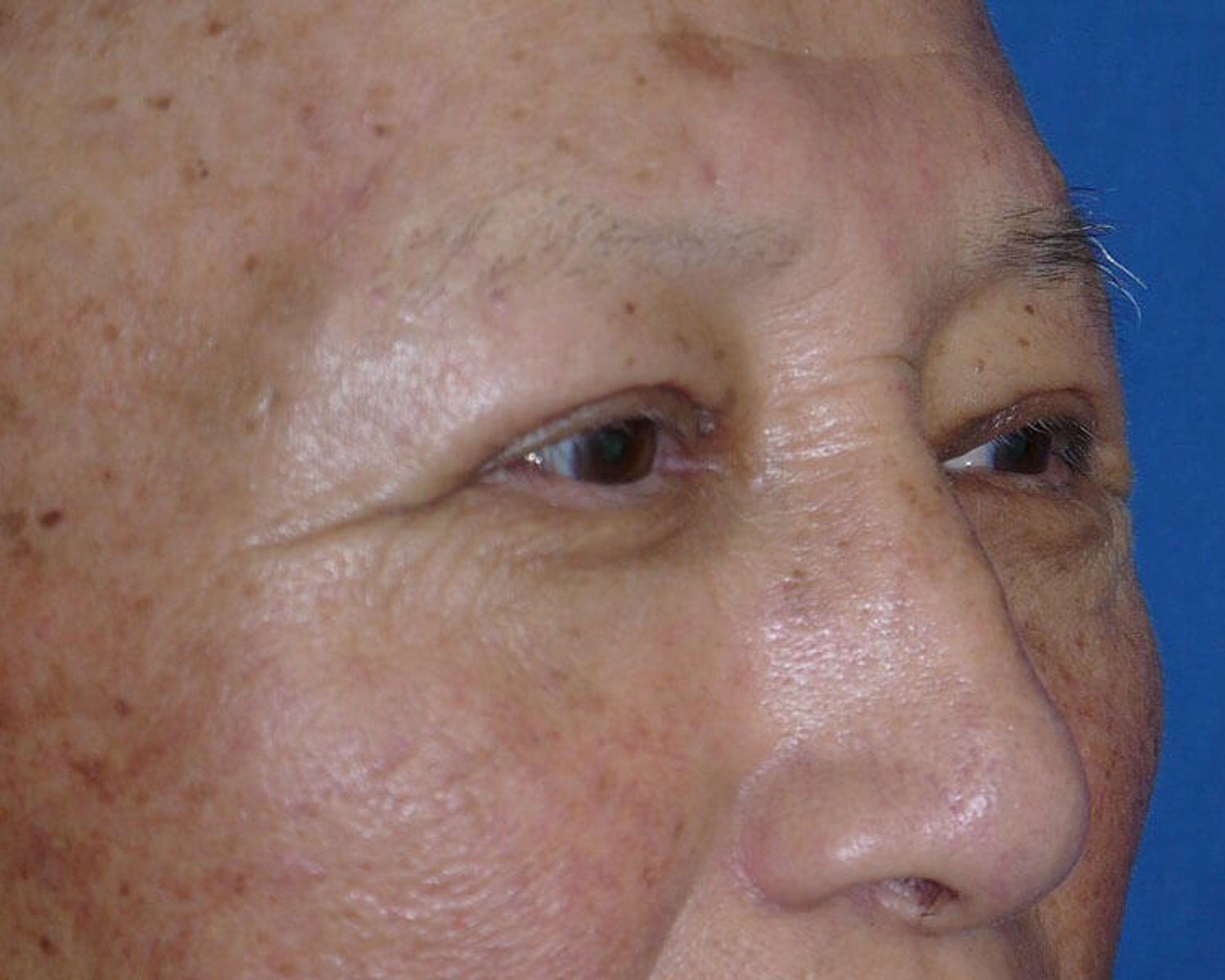Eyelid Surgery after