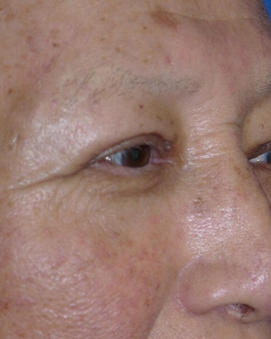 Eyelid Surgery after