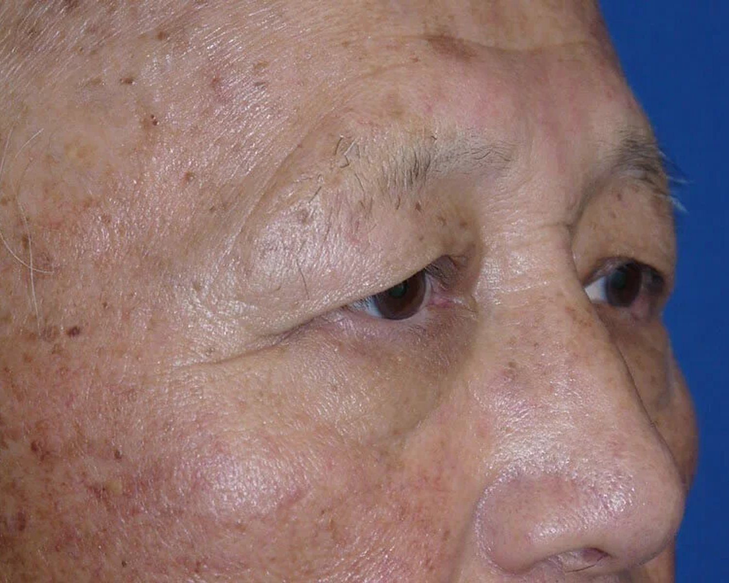 Eyelid Surgery before