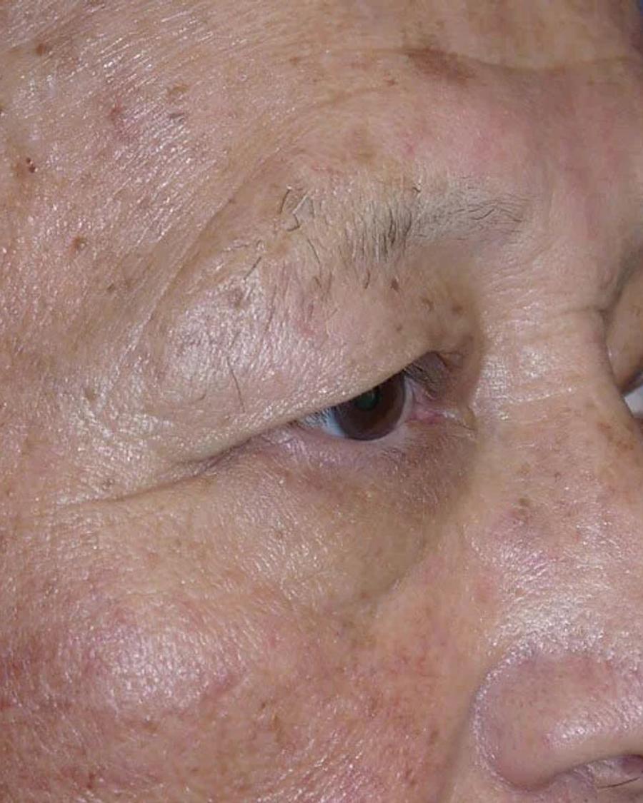 Eyelid Surgery before