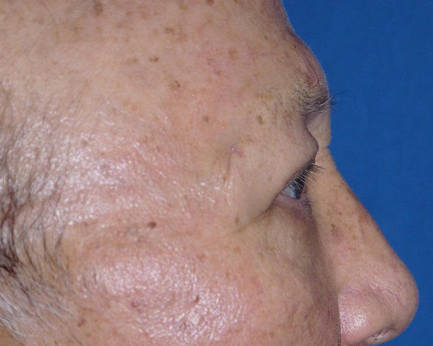 Eyelid Surgery, Right Profile view, after