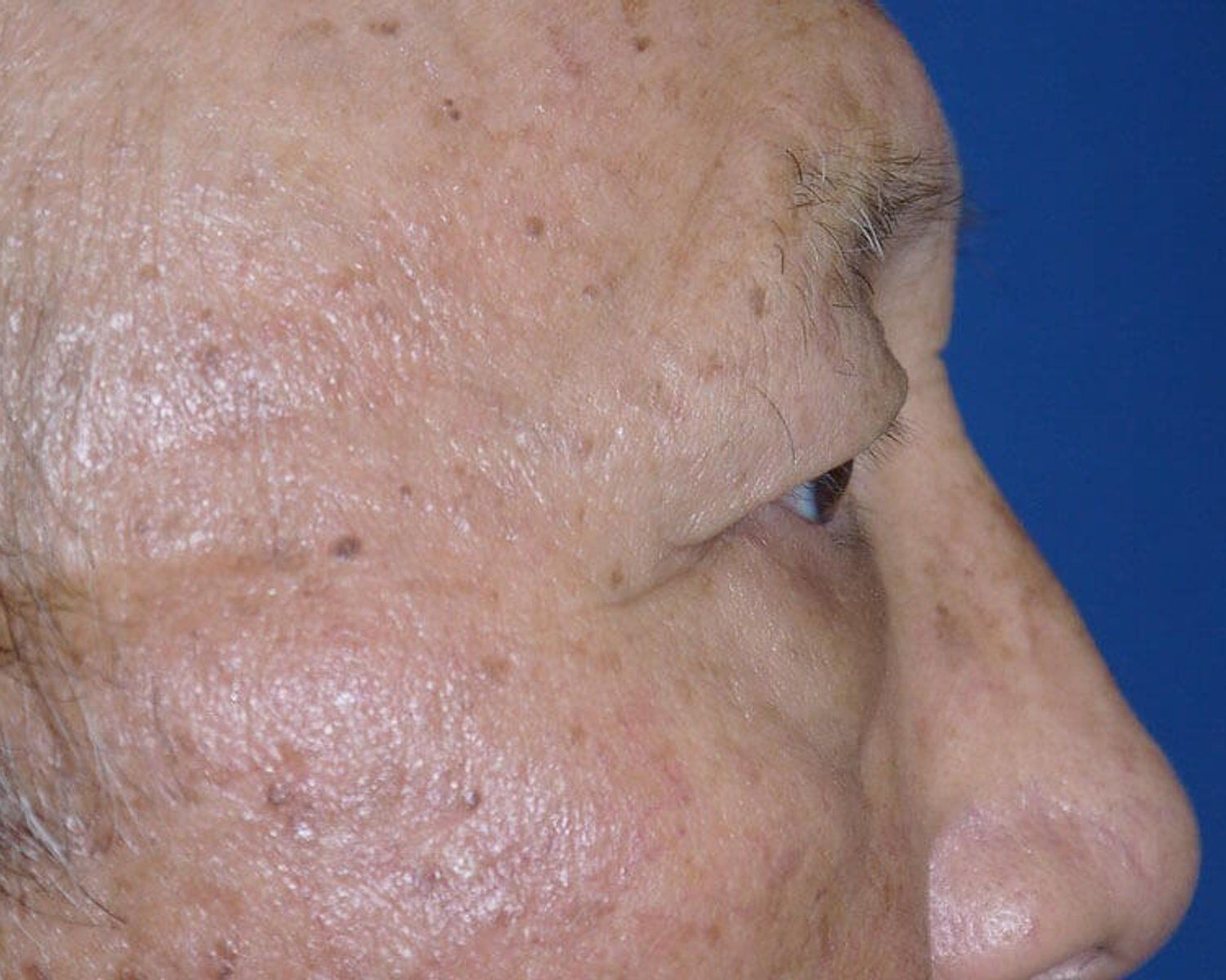 Eyelid Surgery, Right Profile view, before