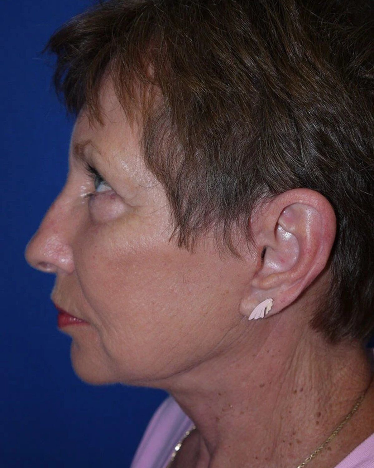 Necklift, Left Profile view, after