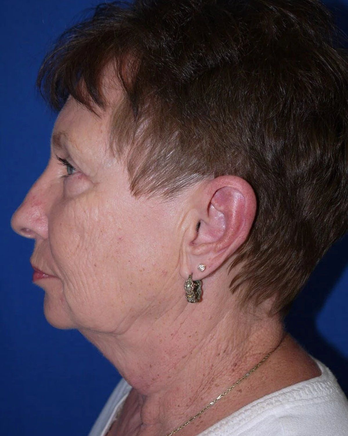 Necklift, Left Profile view, before