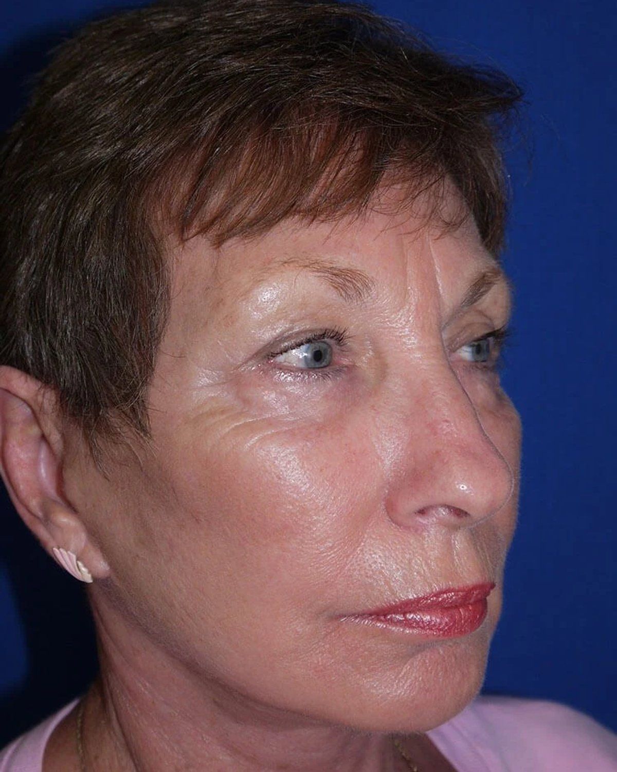Necklift after