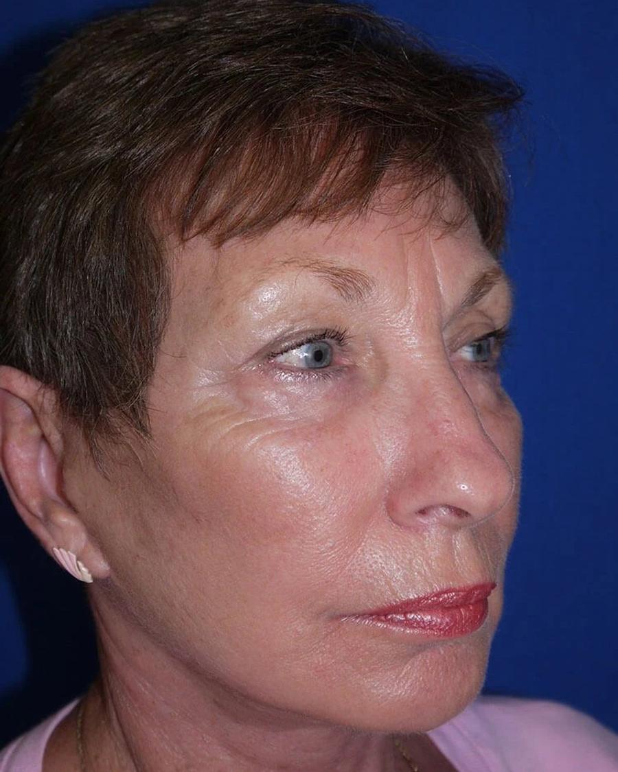 After Necklift