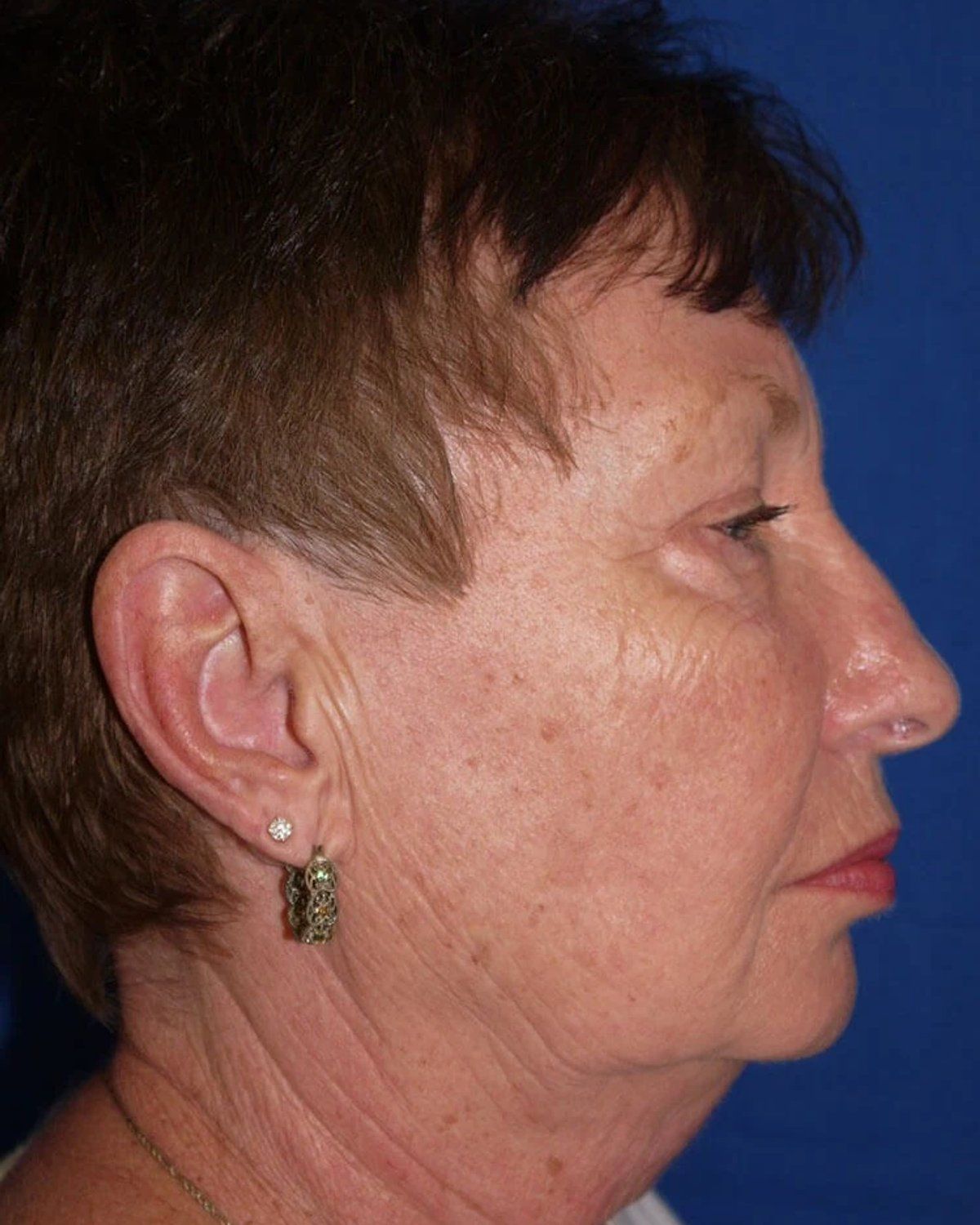 Necklift, Right Profile view, before