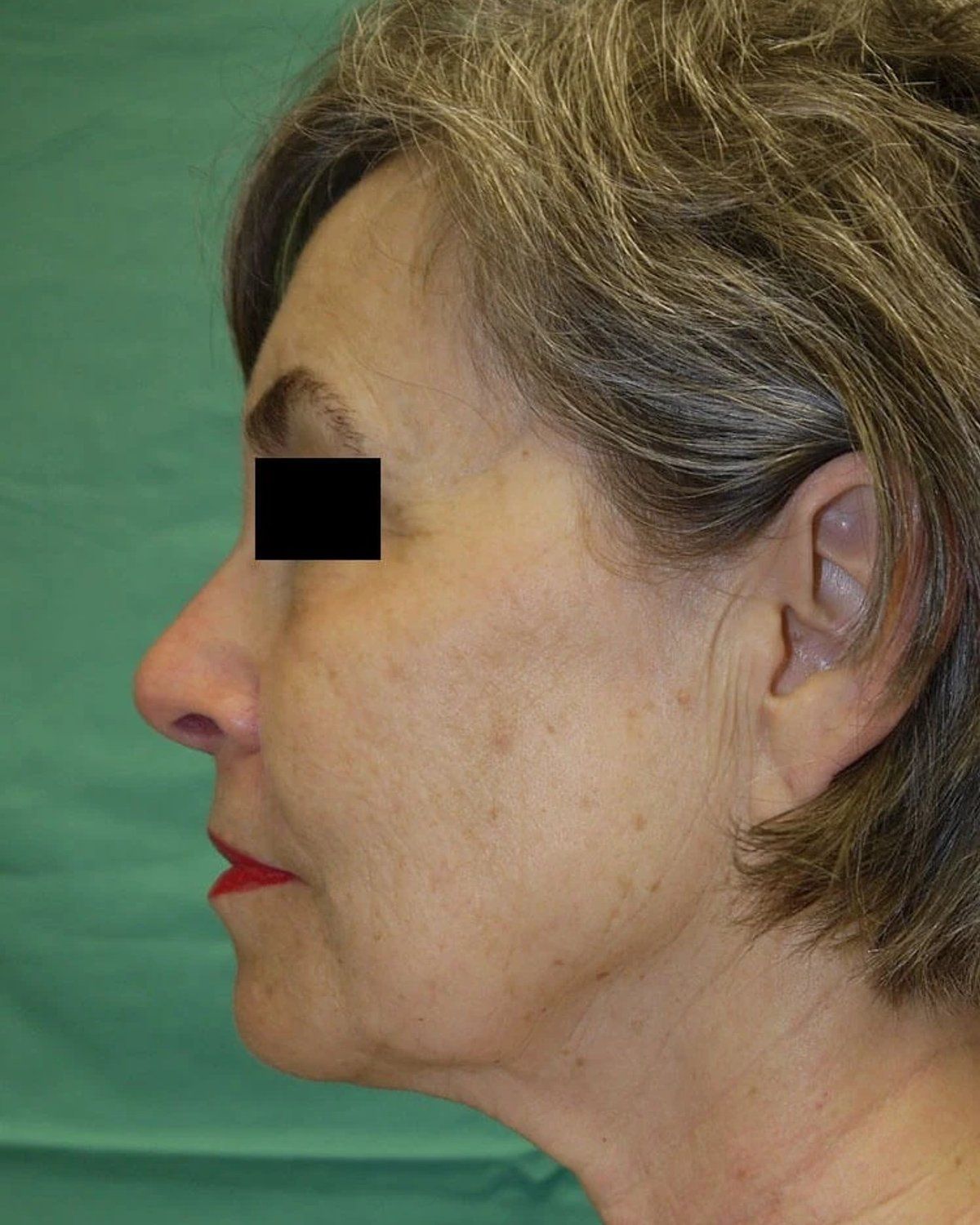 Facelift (neck lift included) — Left Profile view, before