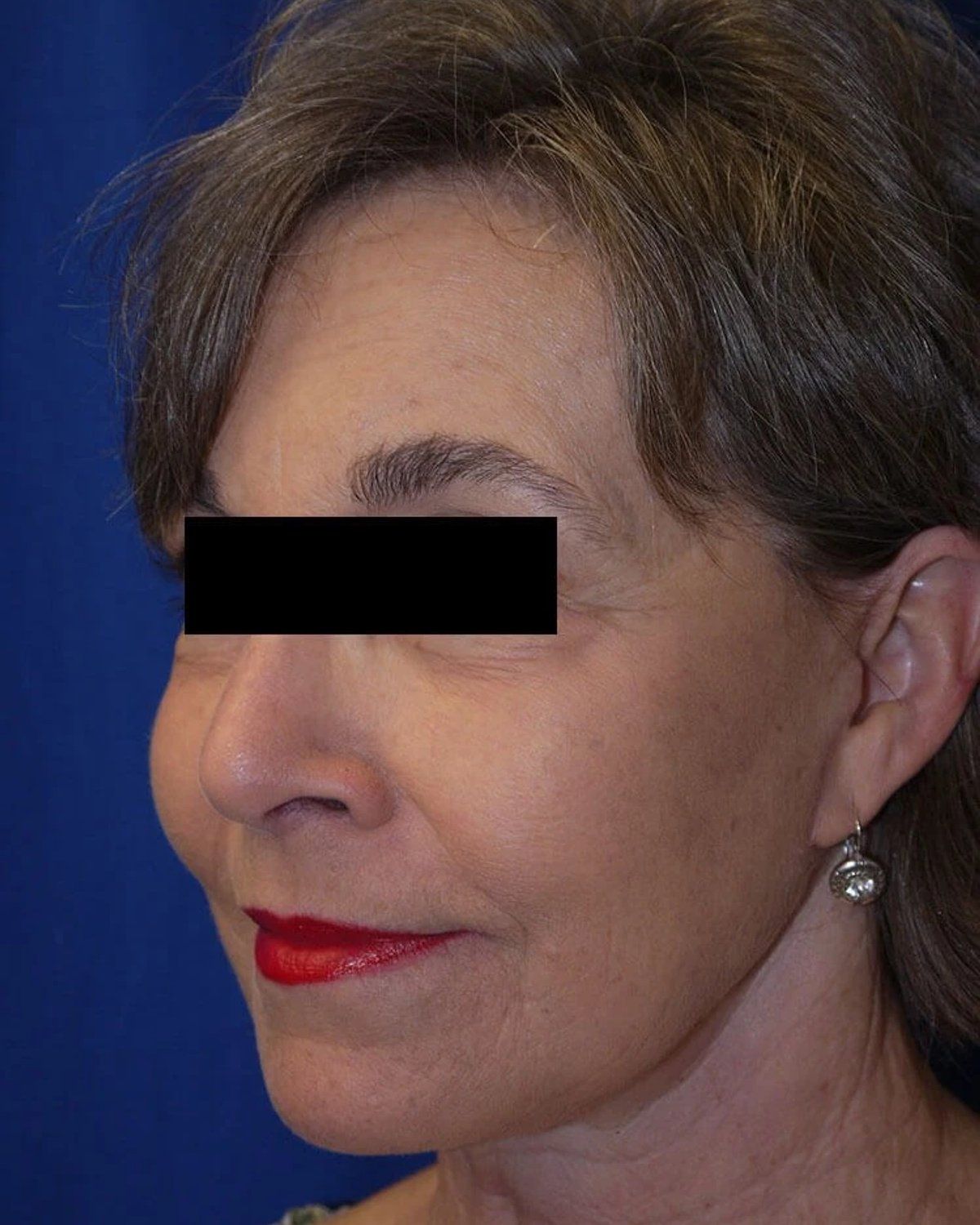 Facelift (neck lift included) — Right Profile view, after