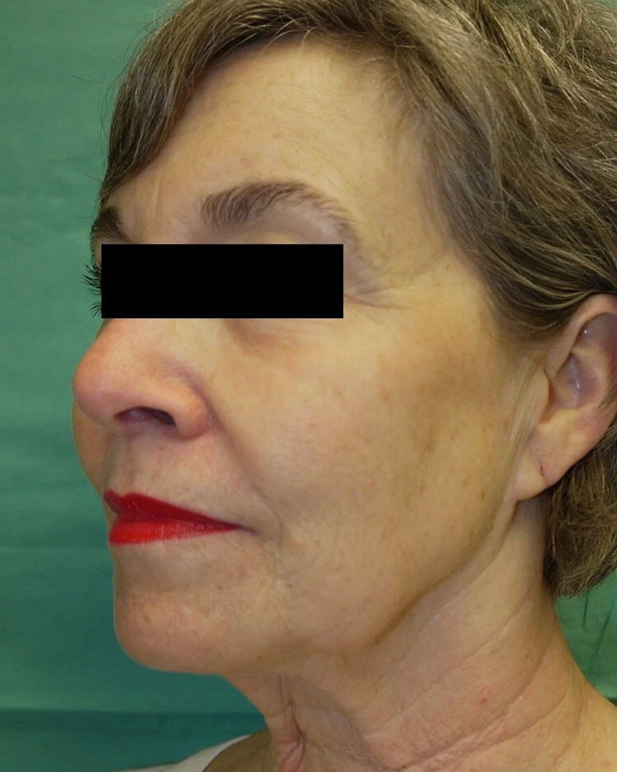 Facelift (neck lift included) — Right Profile view, before