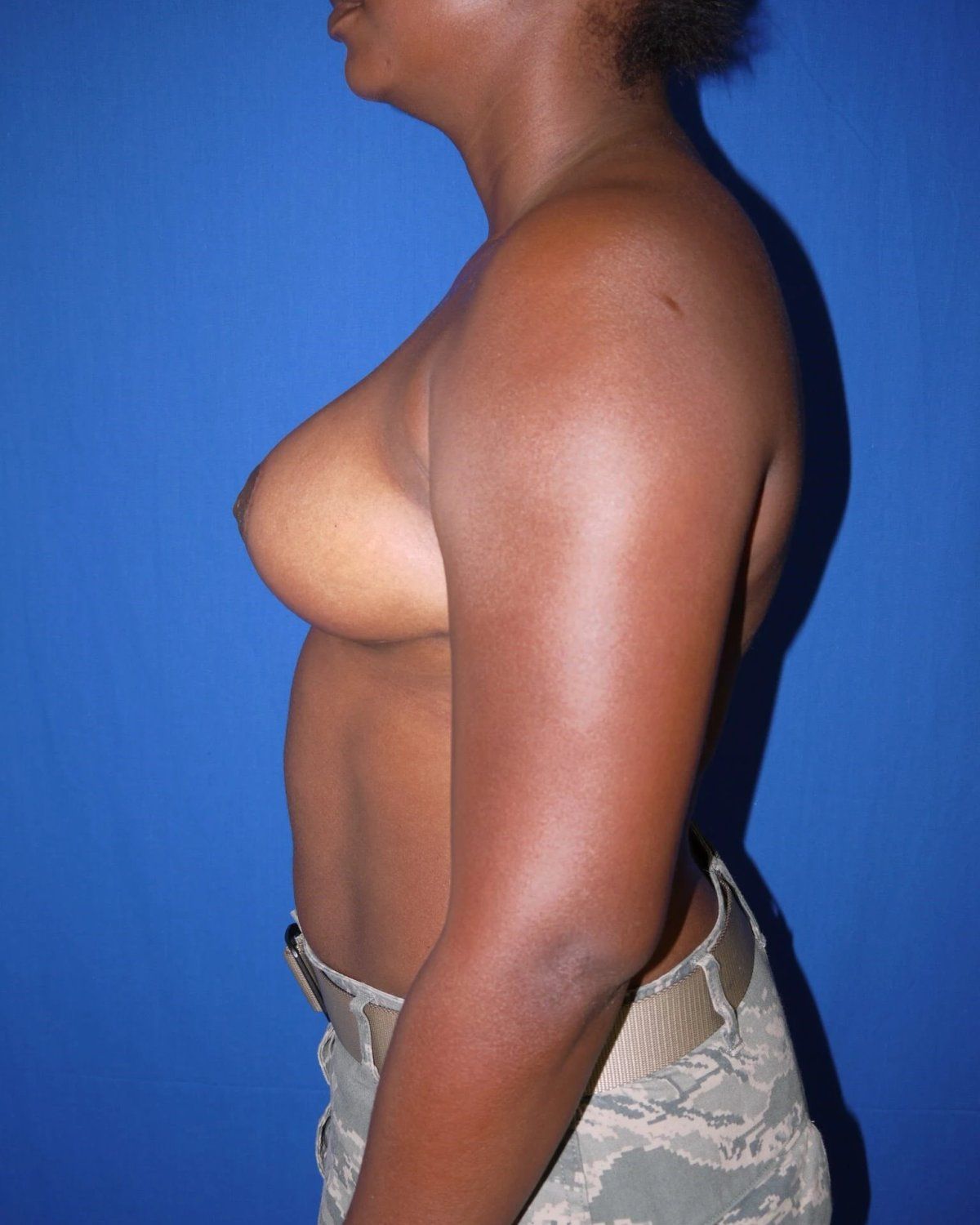 Breast Lift — Left Profile view, after