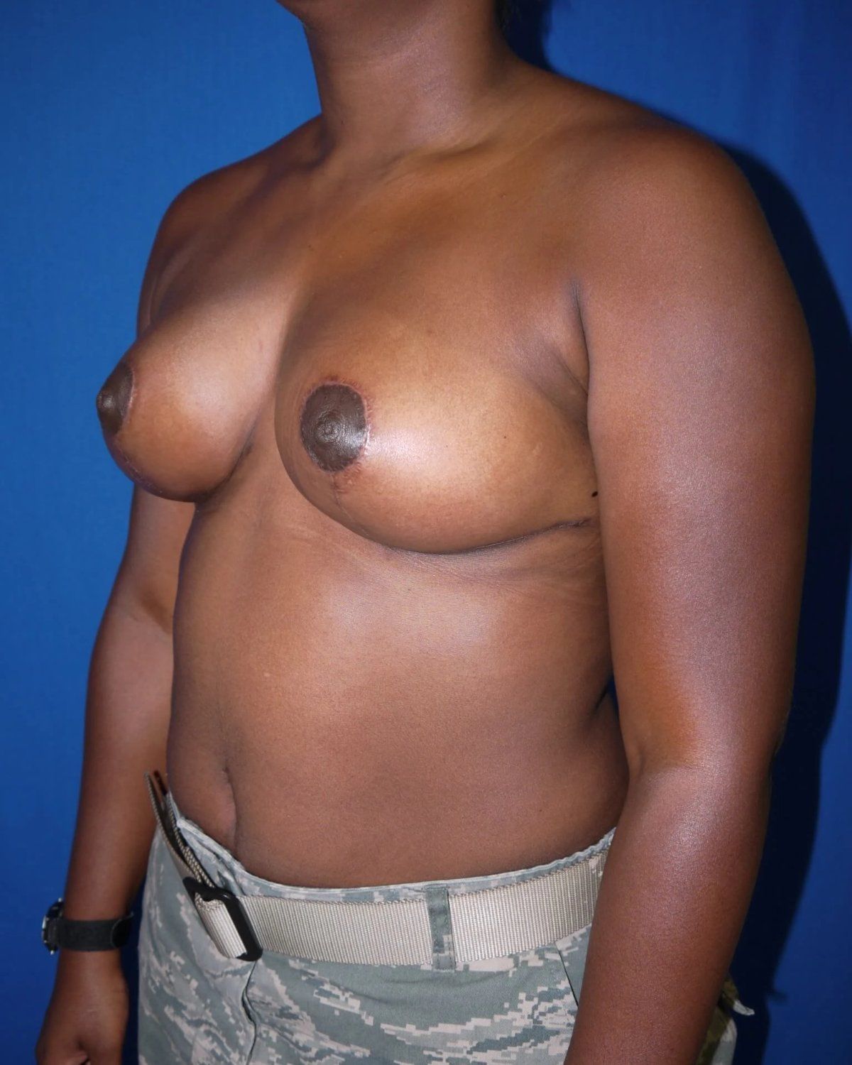 Breast Lift — Oblique Right view, after