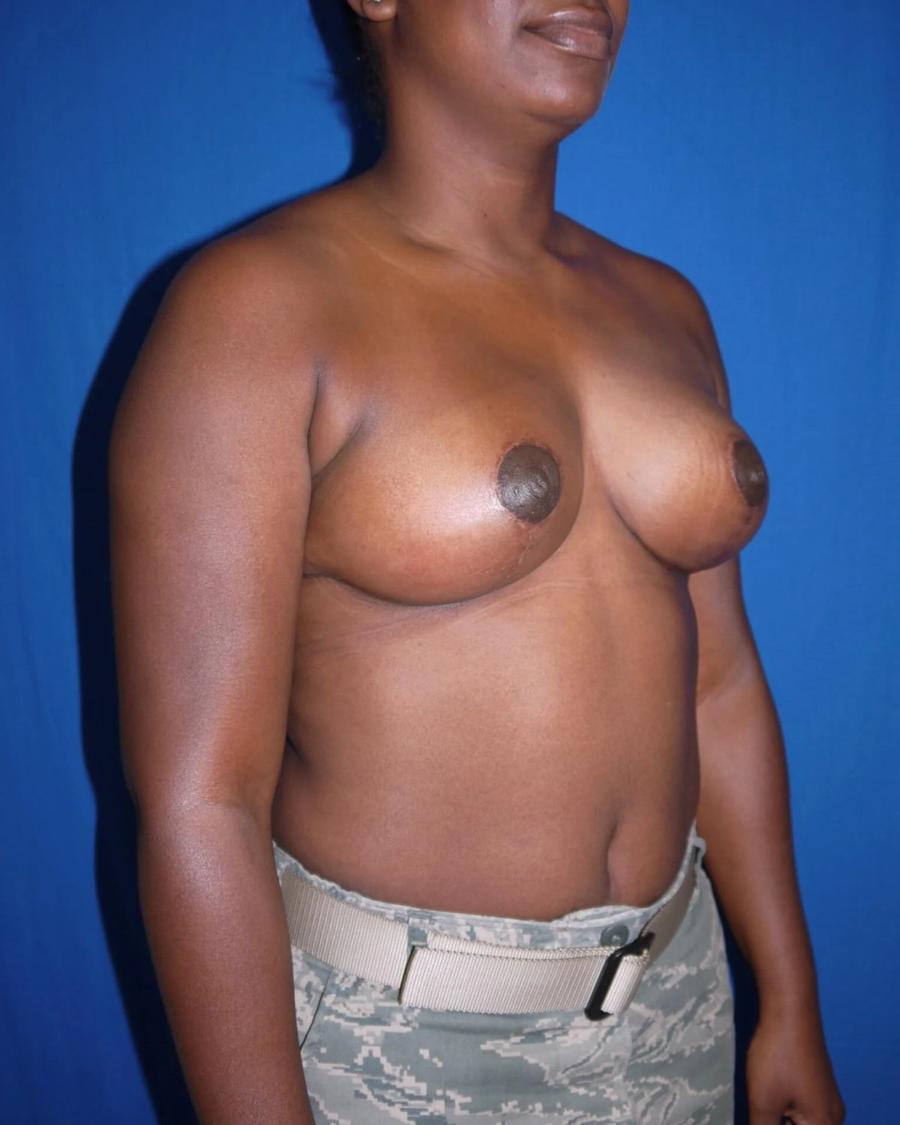 After Breast Lift