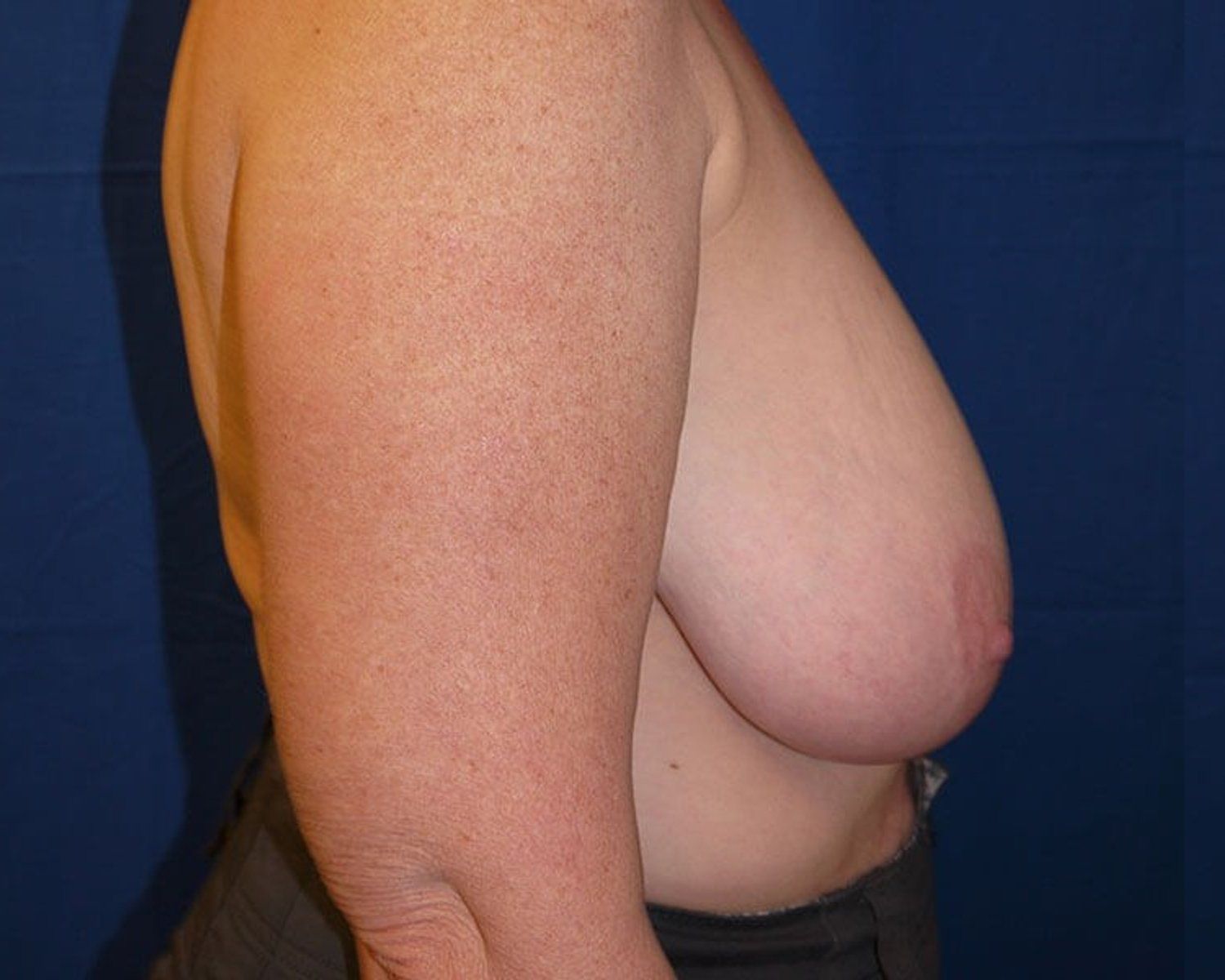 Breast Reduction, Right Profile view, before