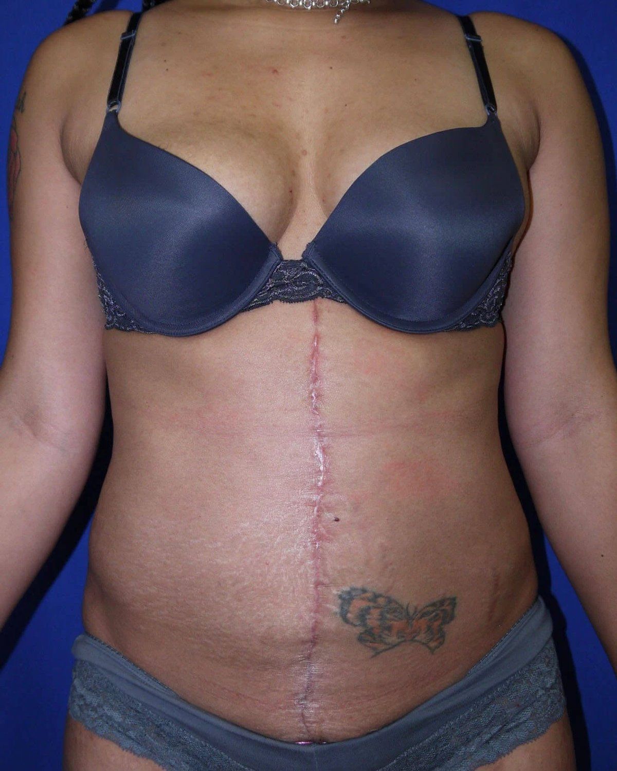 Tummy Tuck after
