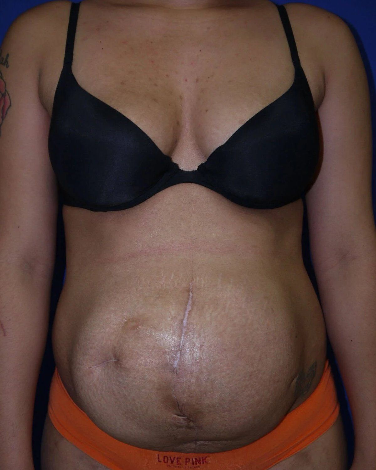 Tummy Tuck before