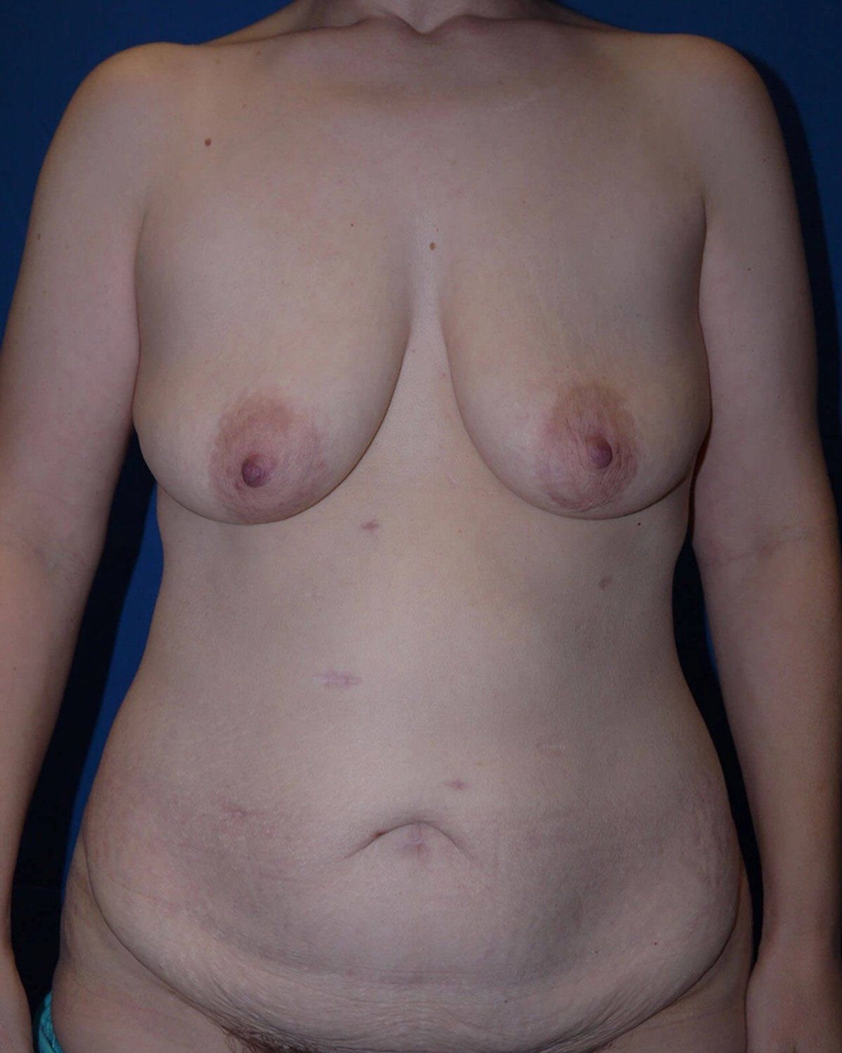 Breast Reduction before
