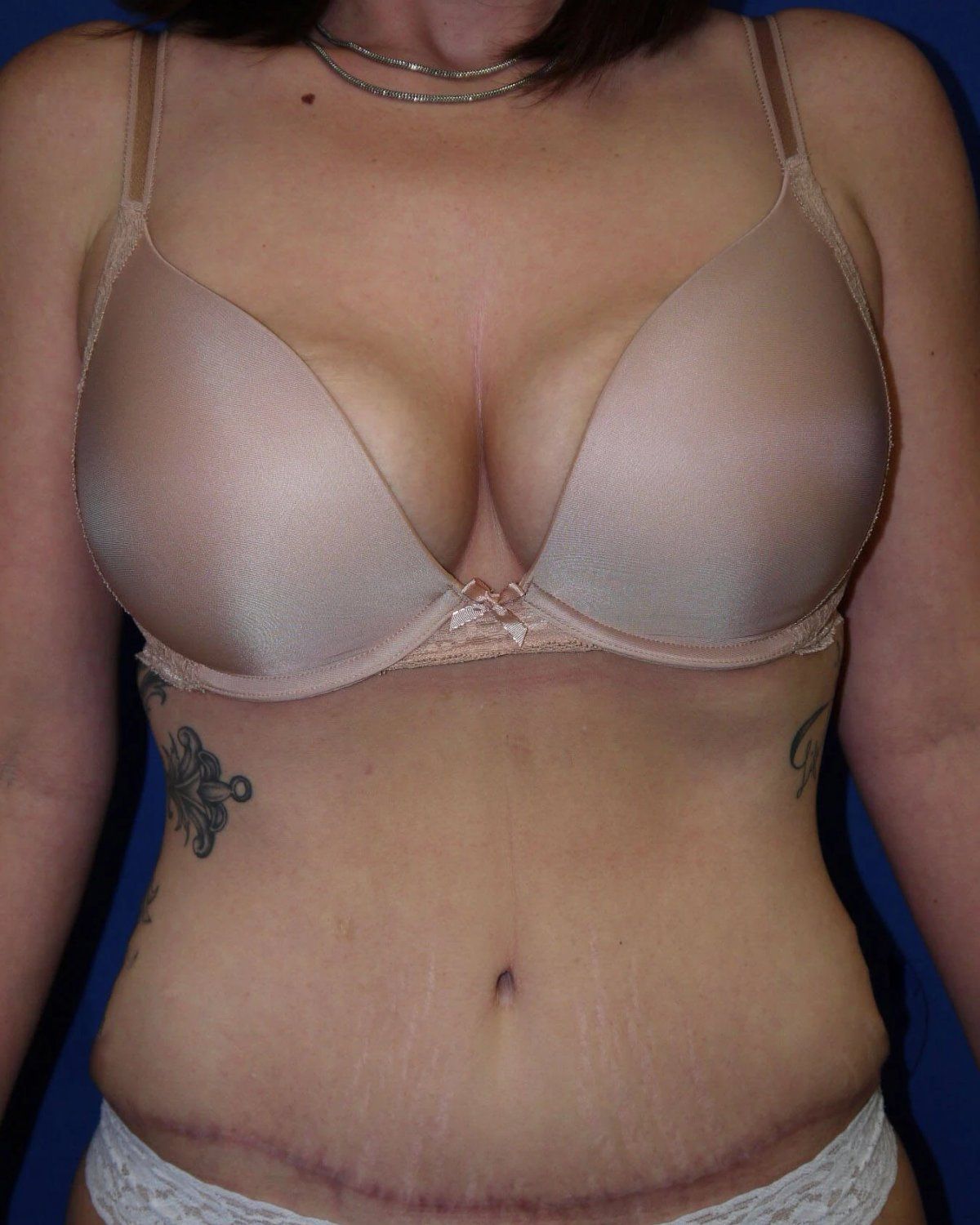 Tummy Tuck after
