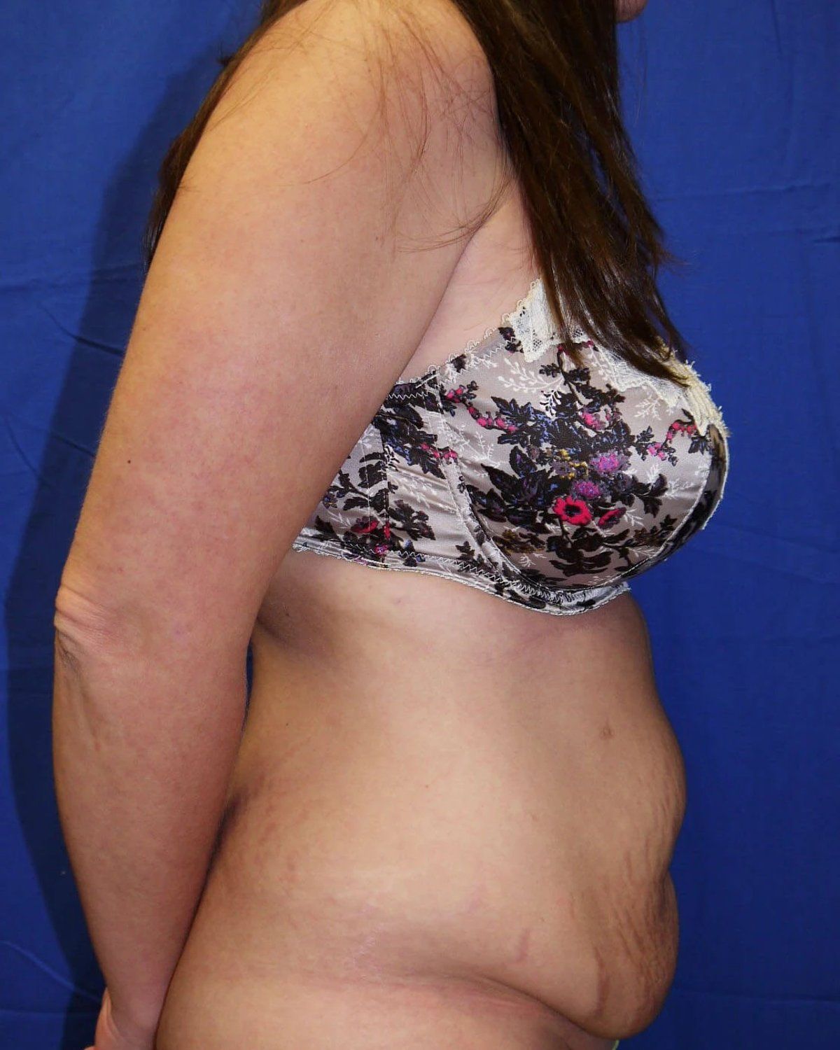 Tummy Tuck — Right Profile view, before