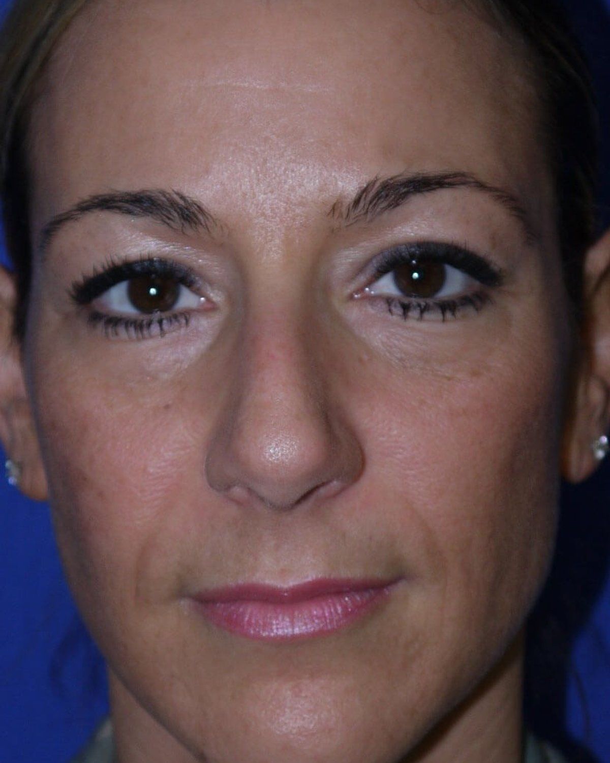 Rhinoplasty after