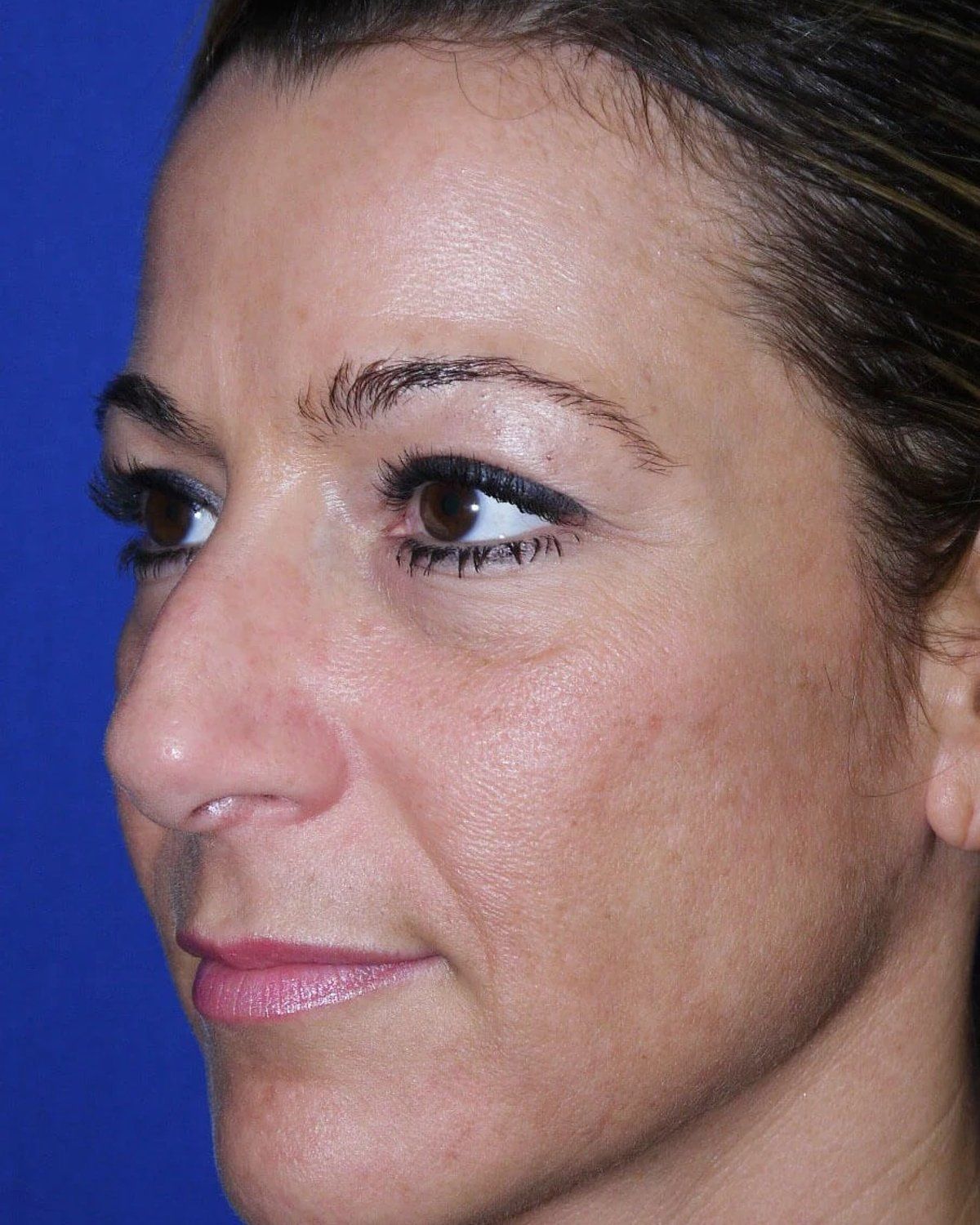 Rhinoplasty, Oblique Right view, before