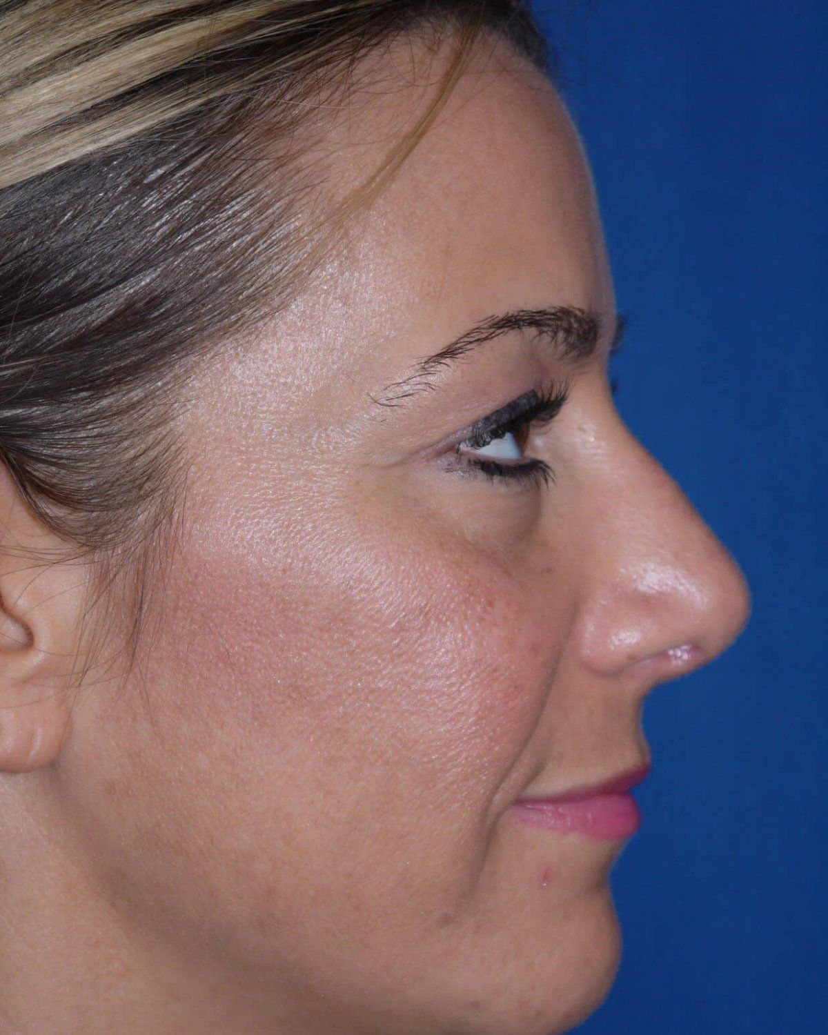 Rhinoplasty, Right Profile view, after