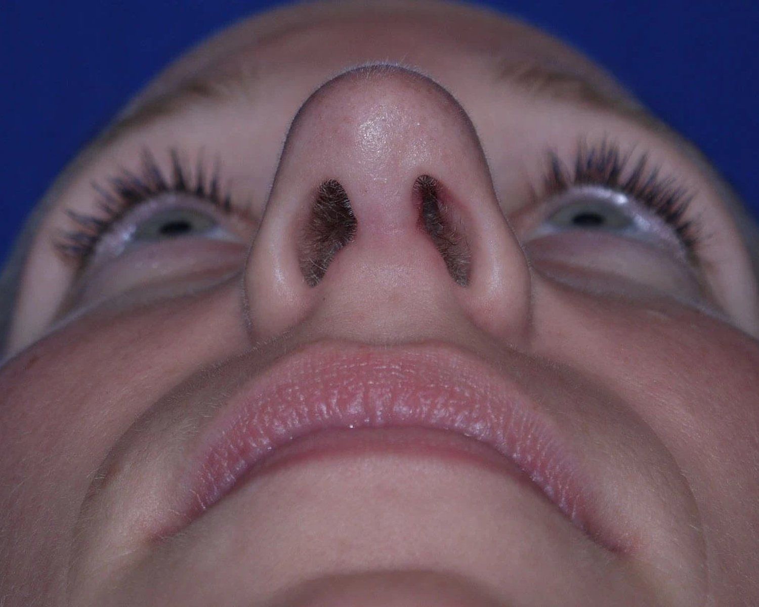 Rhinoplasty after