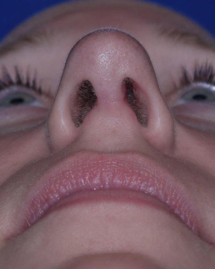 Rhinoplasty after