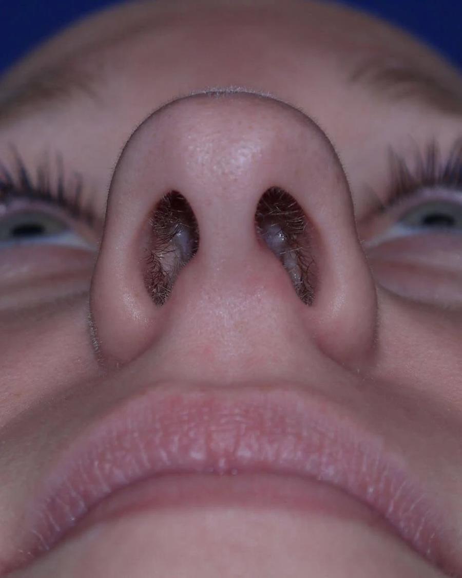 Rhinoplasty before