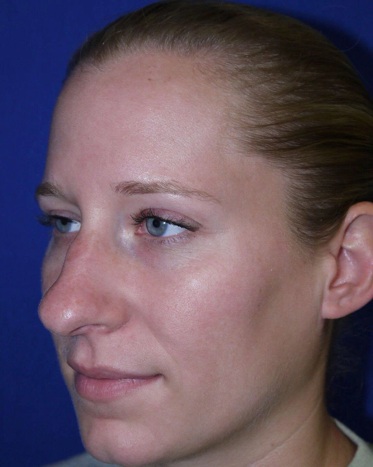 Rhinoplasty, Oblique Right view, before