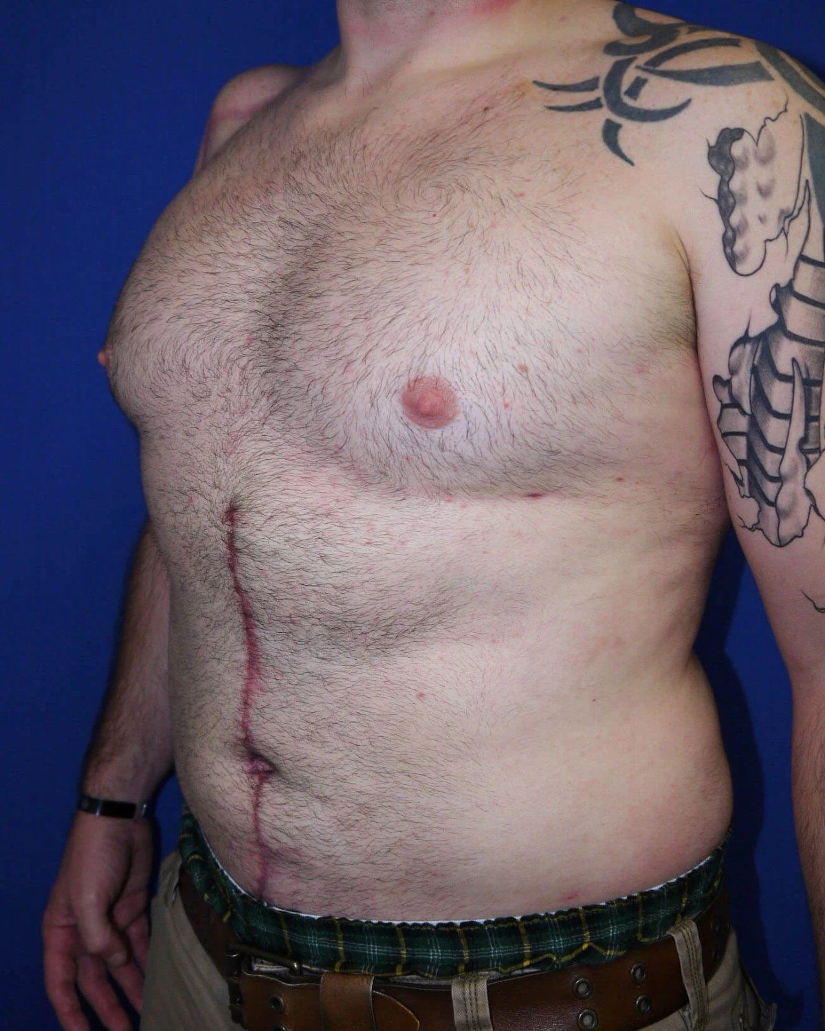 Tummy Tuck after
