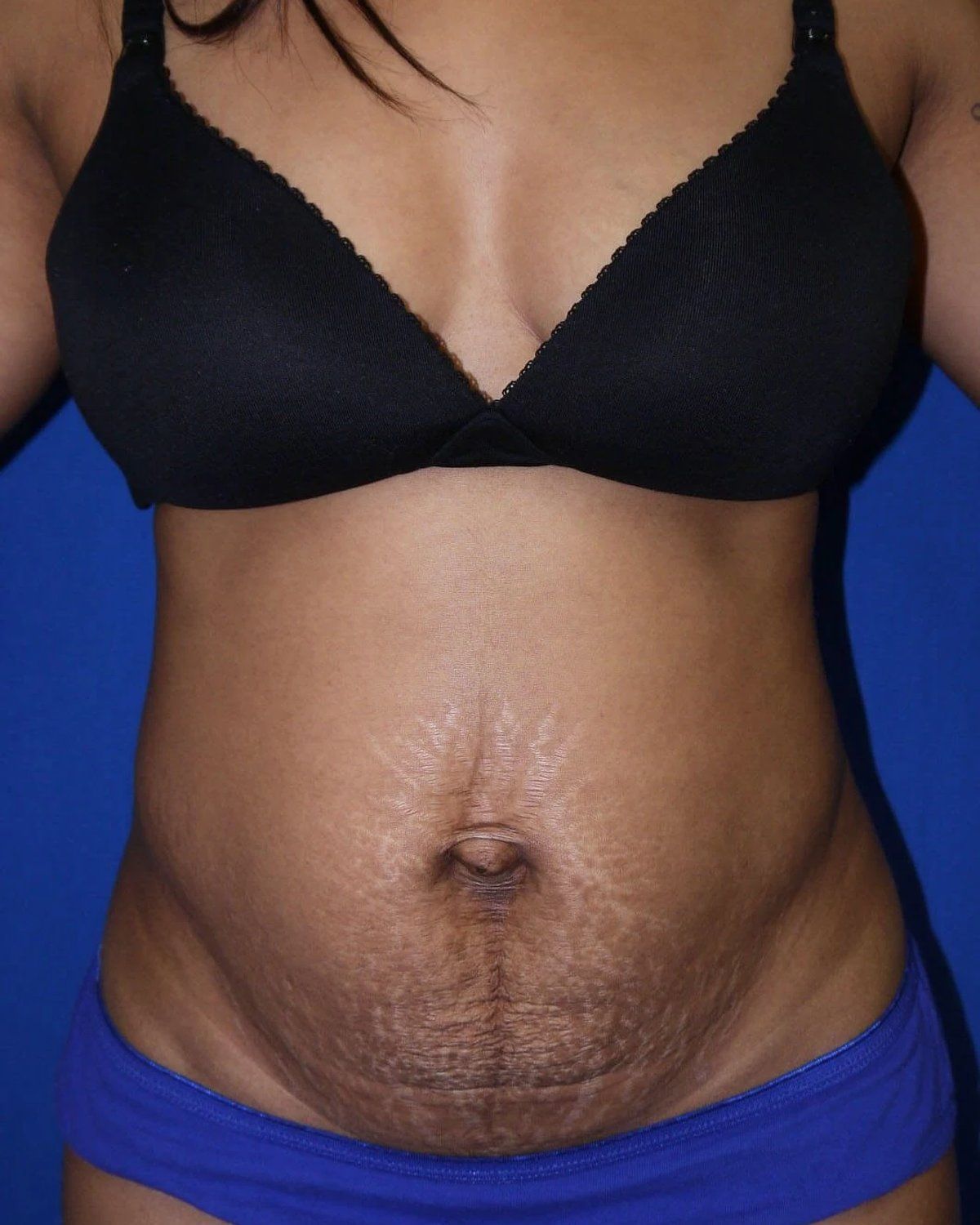 Tummy Tuck before