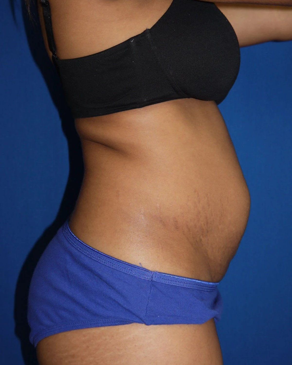 Tummy Tuck — Right Profile view, before