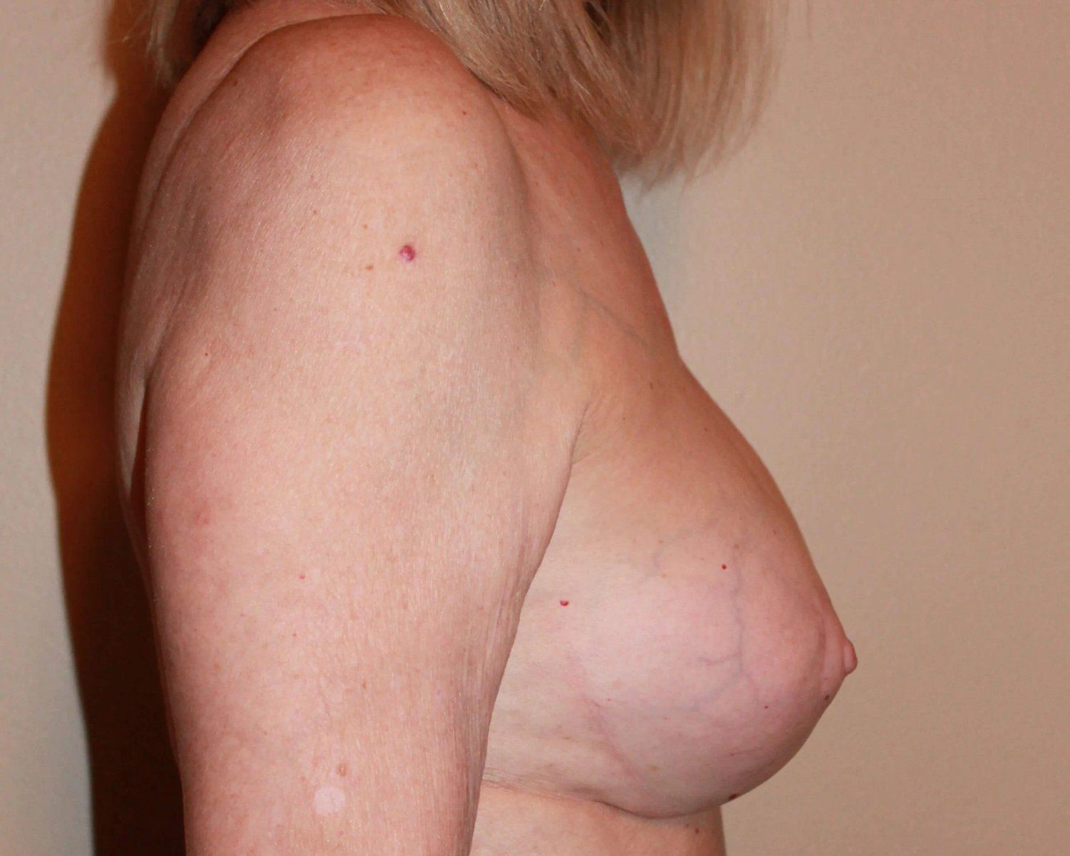 Breast Augmentation with Implants — Right Profile view, after