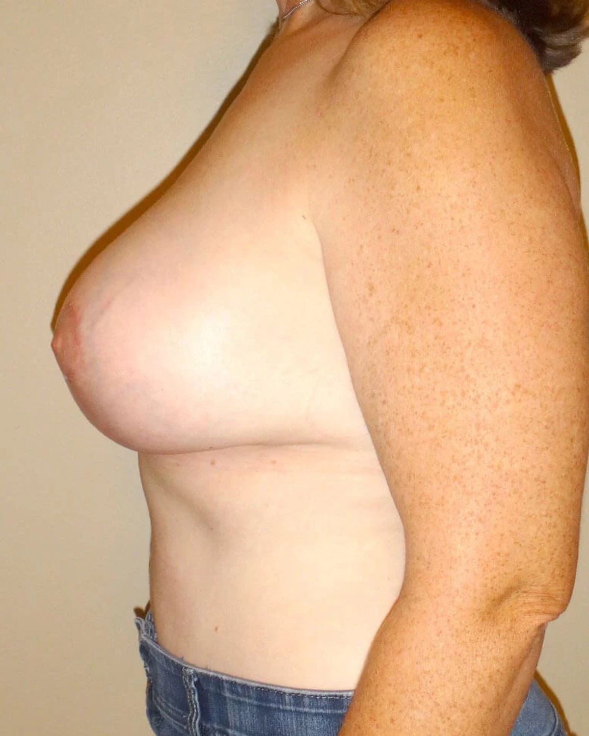 Breast Augmentation with Implants — Left Profile view, after