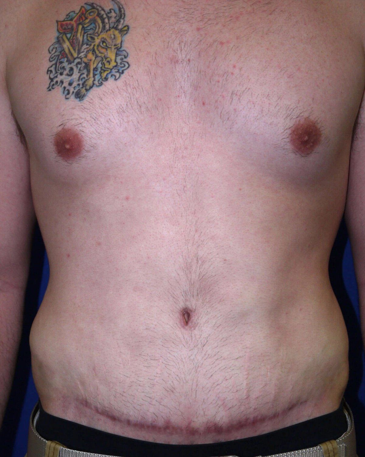 Tummy Tuck after