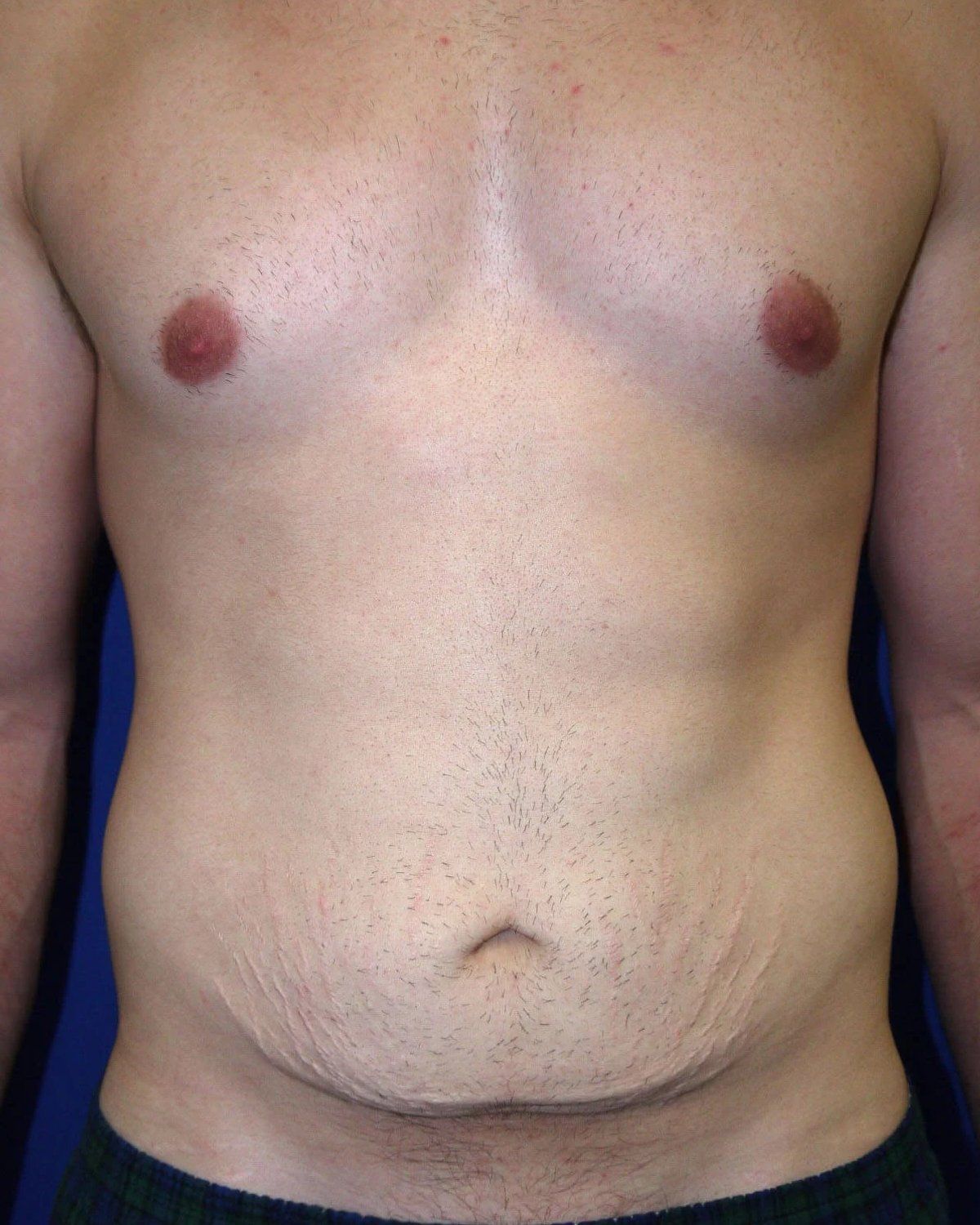 Tummy Tuck before