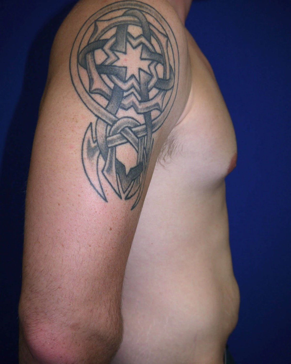 Tummy Tuck — Right Profile view, before