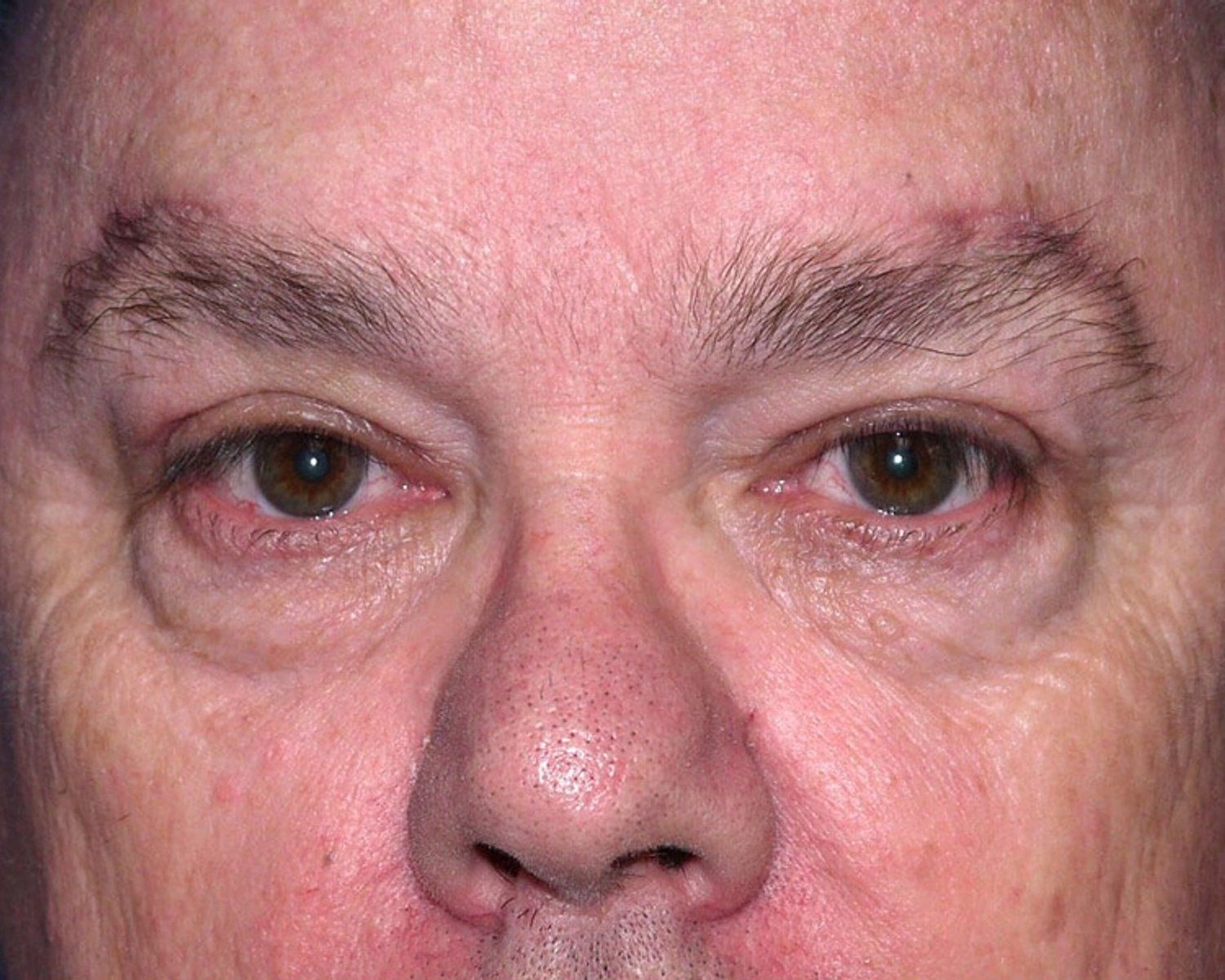 Facelift (neck lift included) after