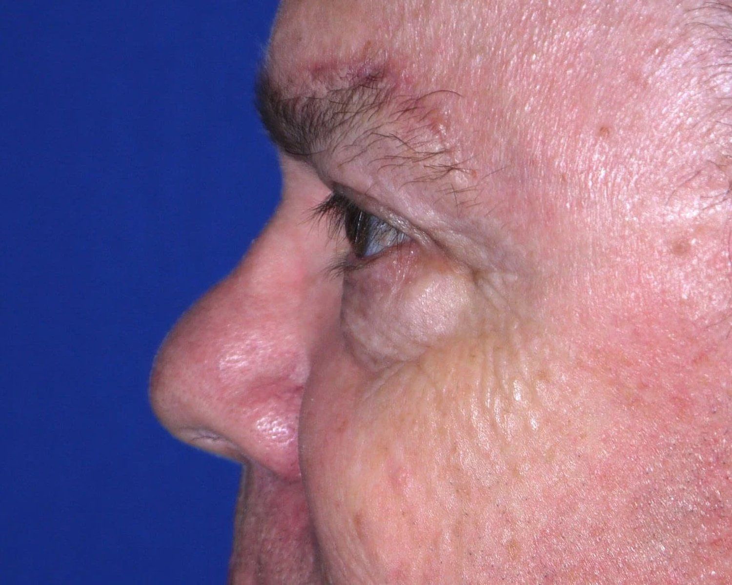 Facelift (neck lift included) — Oblique Left view, after