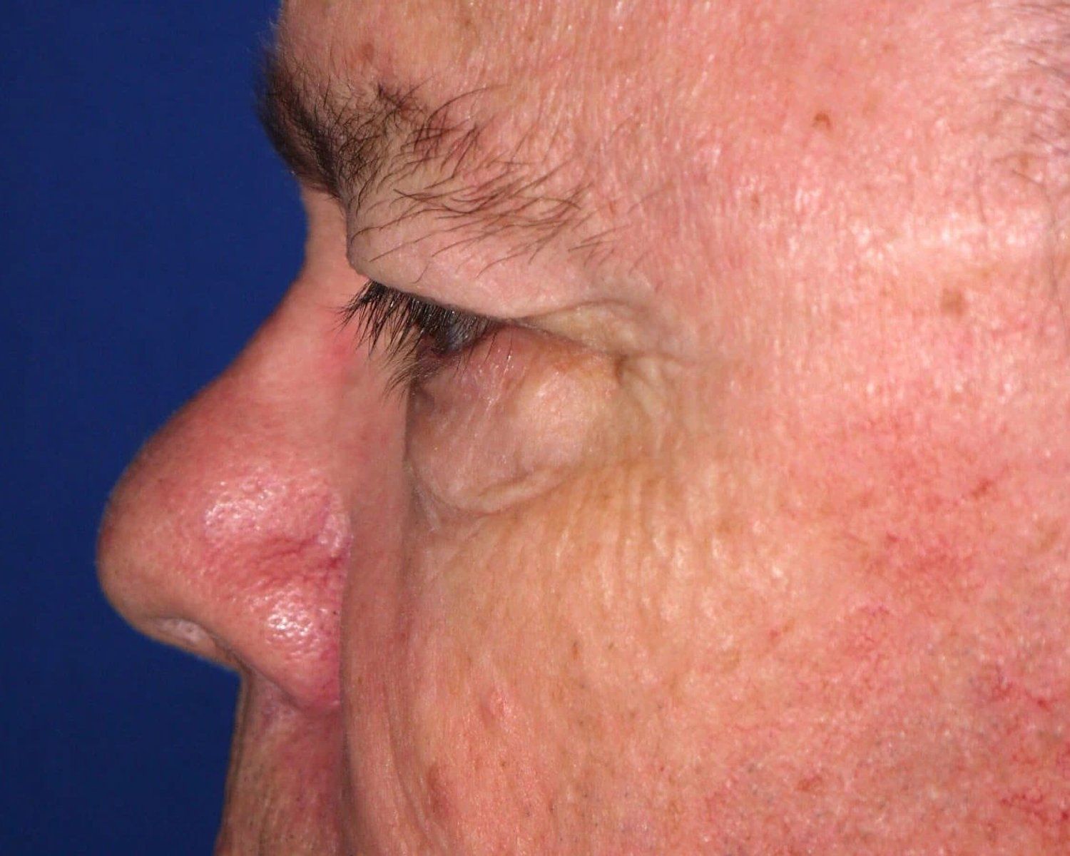 Facelift (neck lift included) — Oblique Left view, before