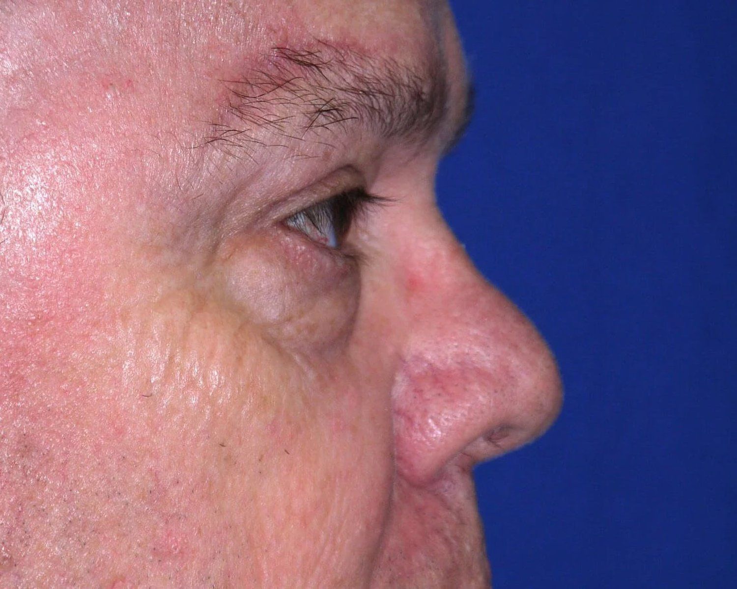 Facelift (neck lift included) — Oblique Right view, after