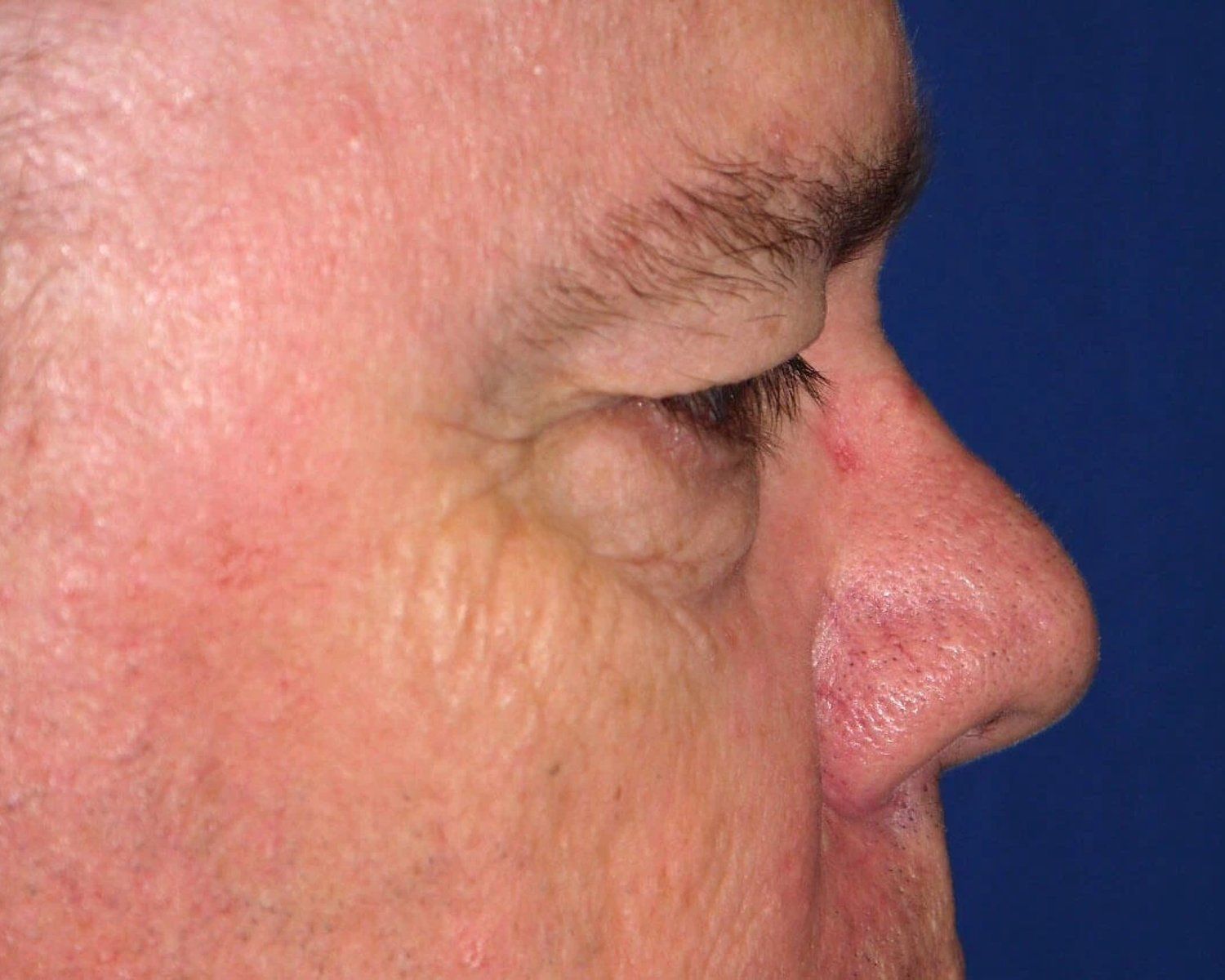 Facelift (neck lift included) — Oblique Right view, before