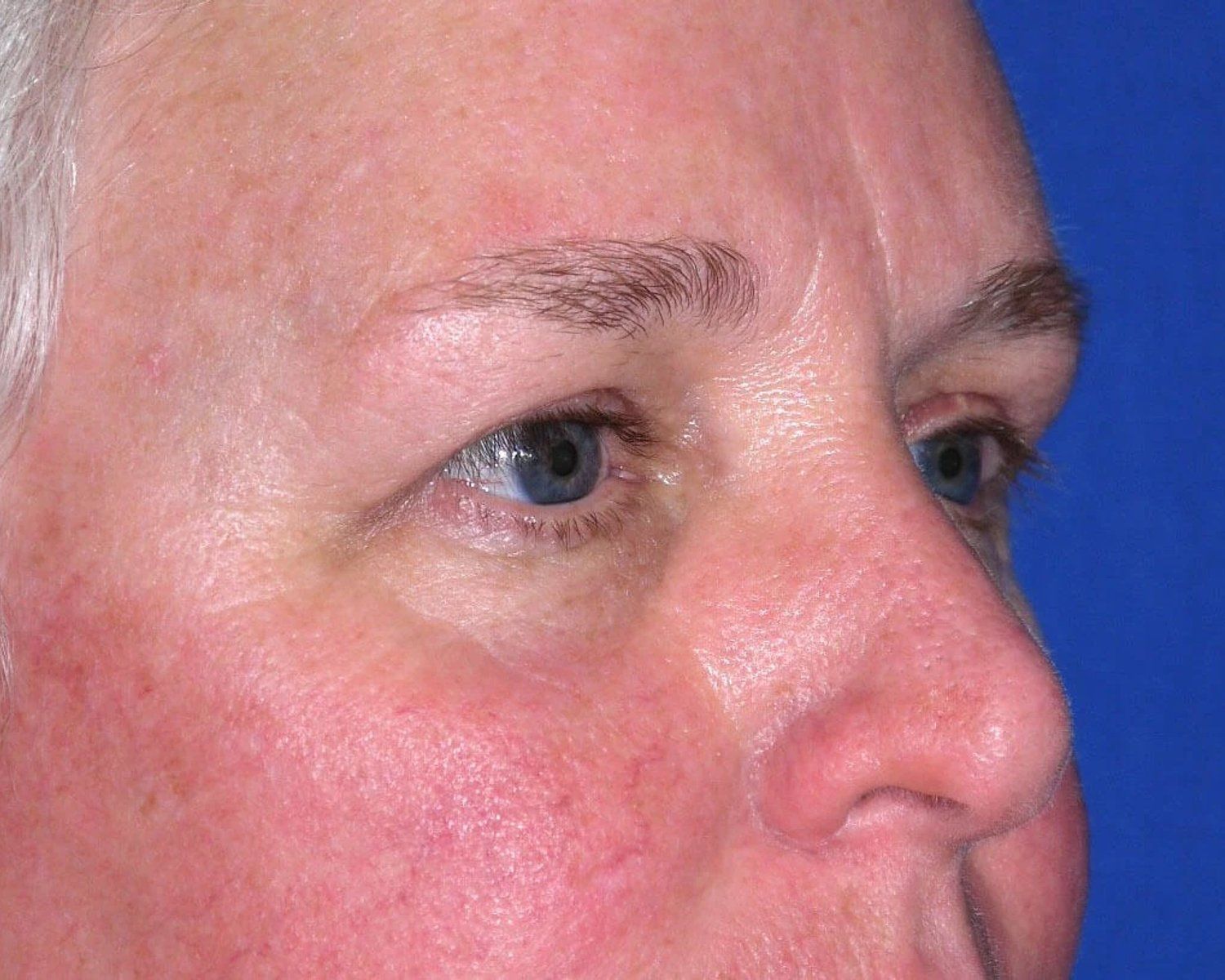 Facelift (neck lift included) — Oblique Right view, after