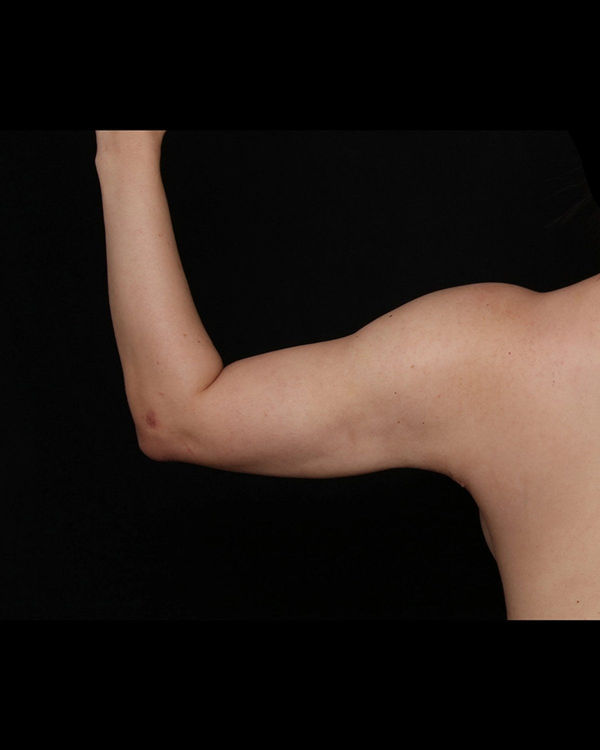 Arm Lift after