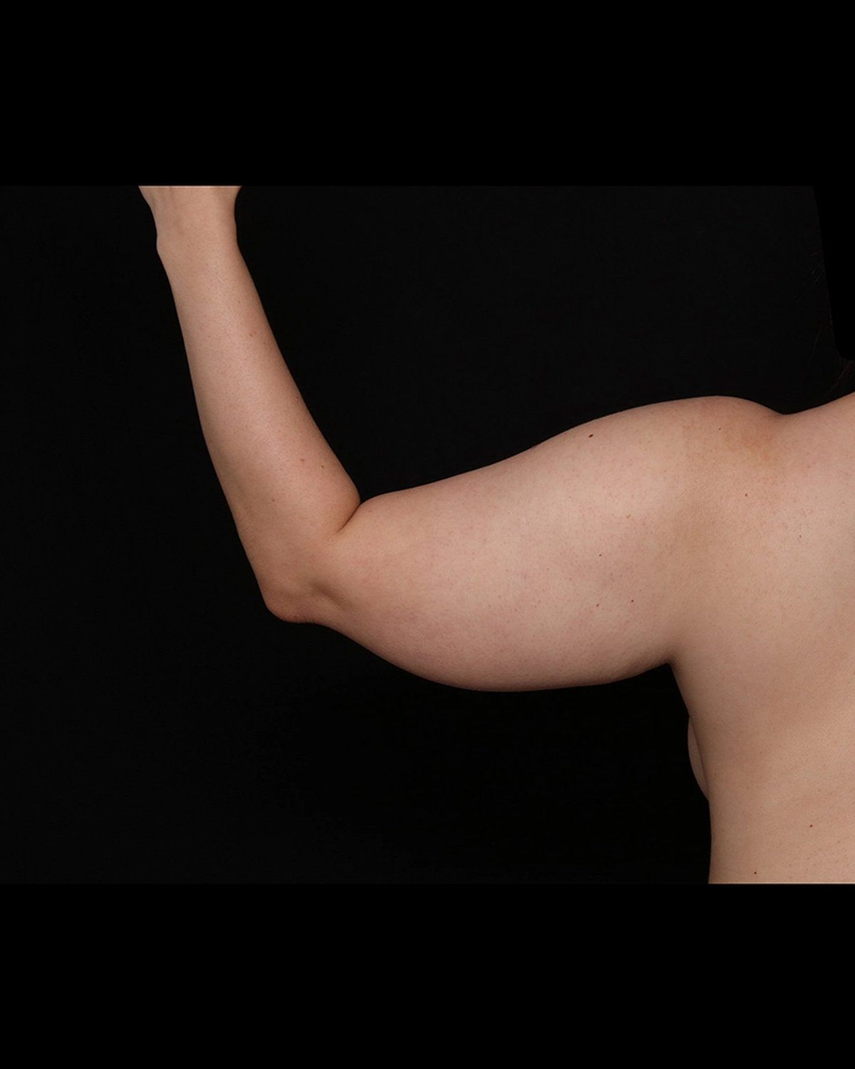 Arm Lift before