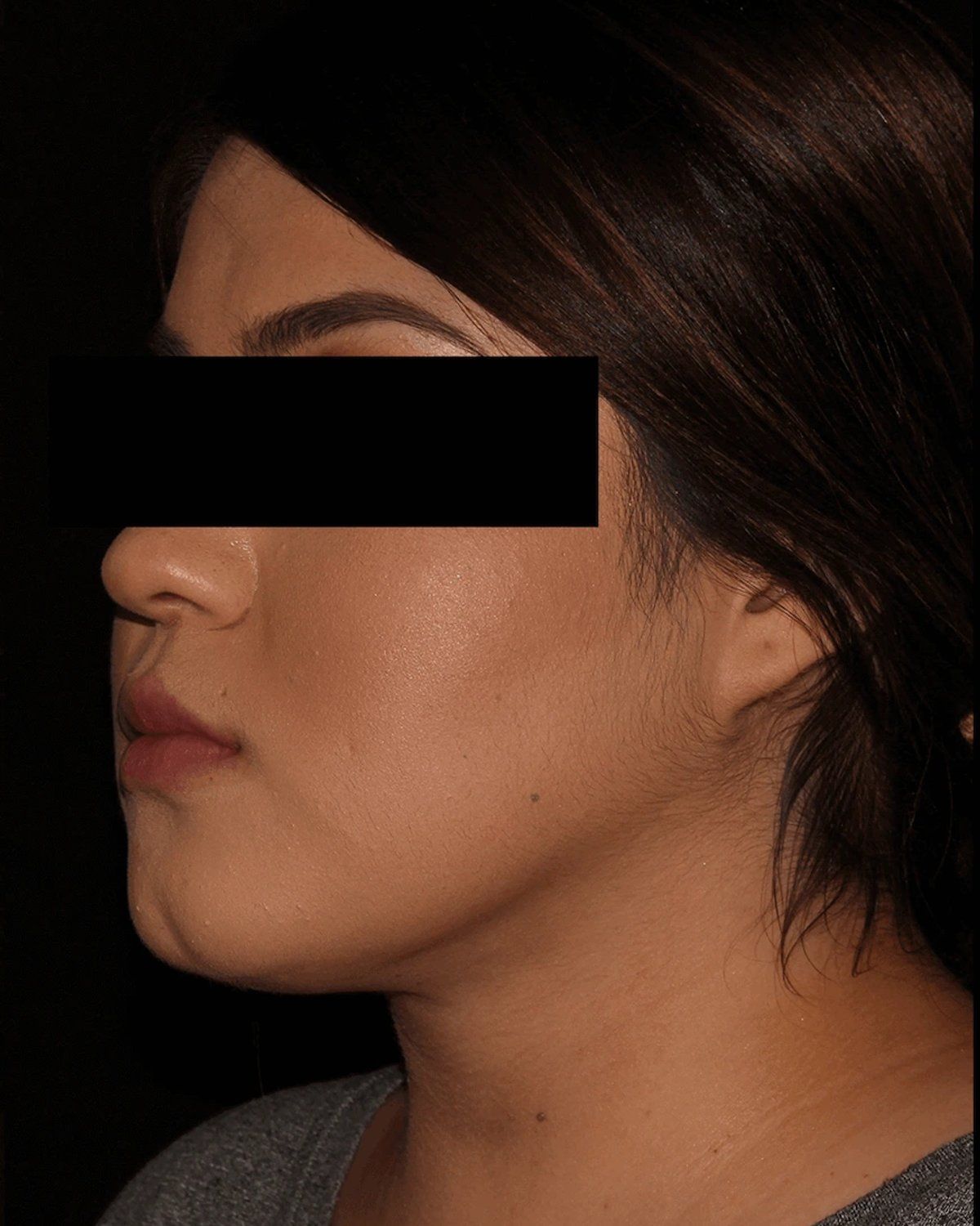 Front Liposuction (5L) (Same As Lipo360) after