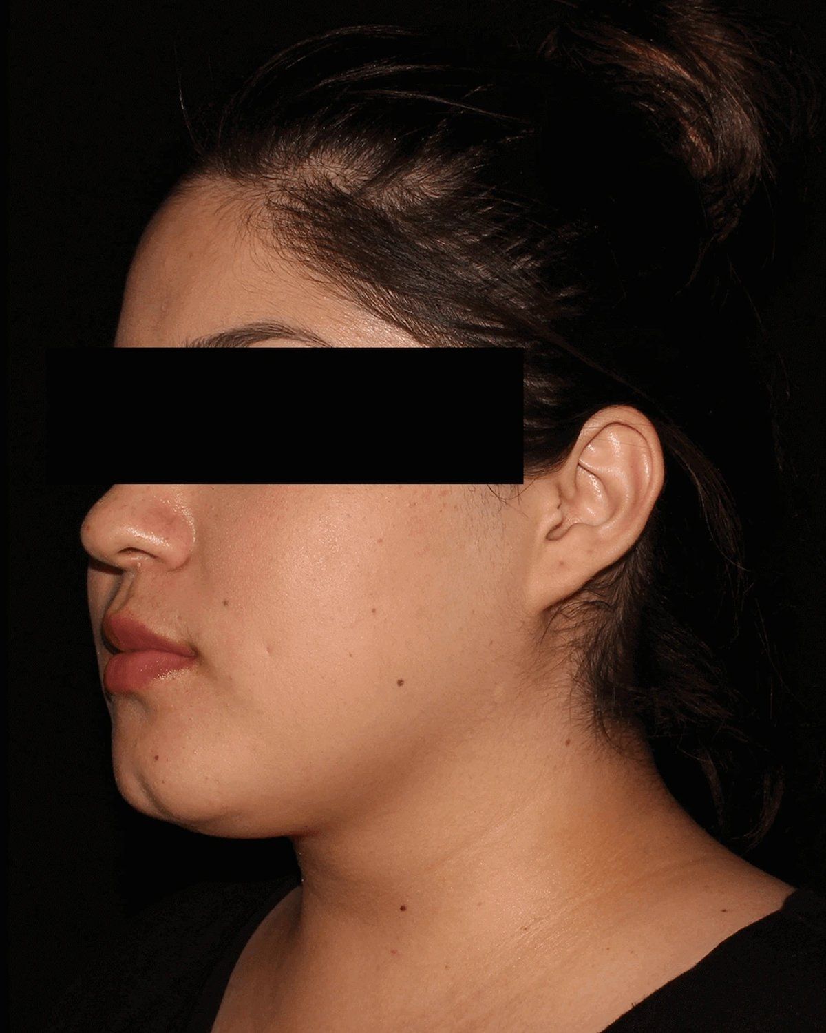 Front Liposuction (5L) (Same As Lipo360) before